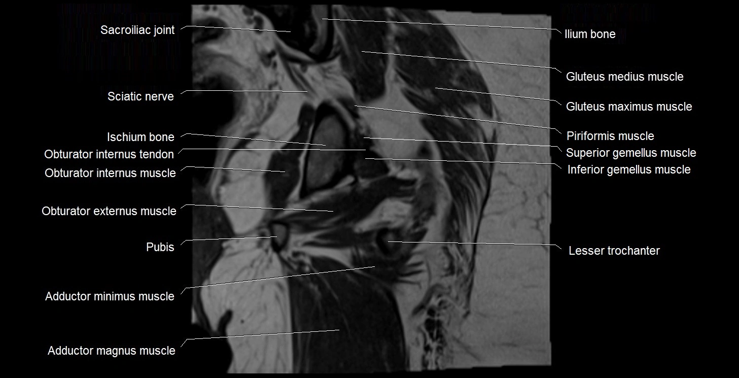 MRI Hip 3T coronal cross sectional anatomy image 44.webp